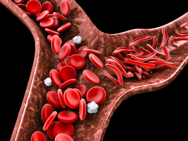 Sickle cell anemia, 3D illustration showing blood vessel with normal and deformed crescent.